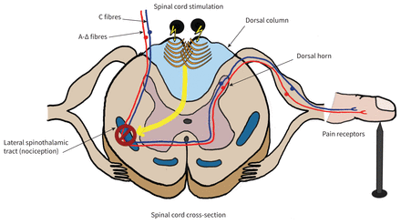 Spinal Column and Peripheral Nerve Stimulator - Back Pain Treatment