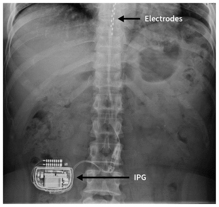 Stimwave, Peripheral Nerve Stimulation for Chronic Pain — Advanced